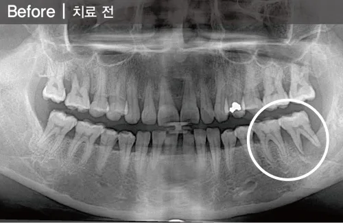 BMP를 이용한 심한 풍치환자에서 발치 후 즉시식립 치료 전